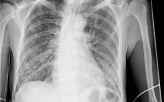 “A pneumonia da Covid-19 é muito diferente da comum. Ela evolui com fibrose pulmonar”.